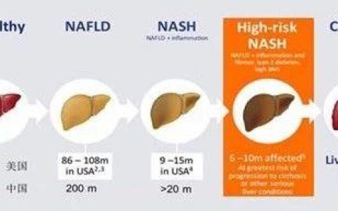 综述 | NASH主要靶点新药动物和临床研究进展