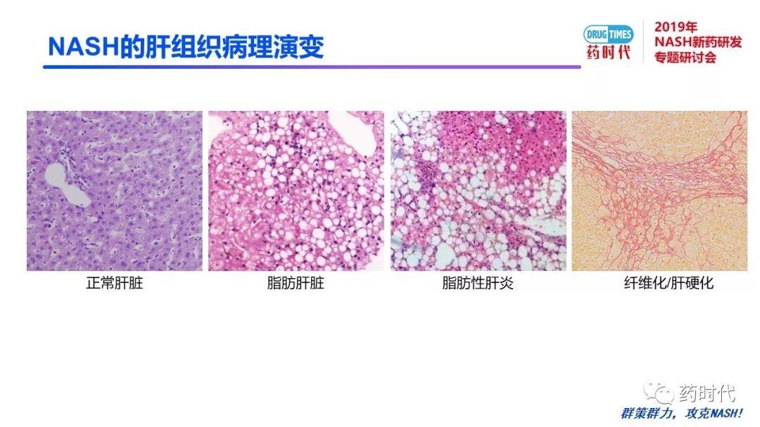 庄永傑博士 | NASH新药研发相关试验动物模型的分析