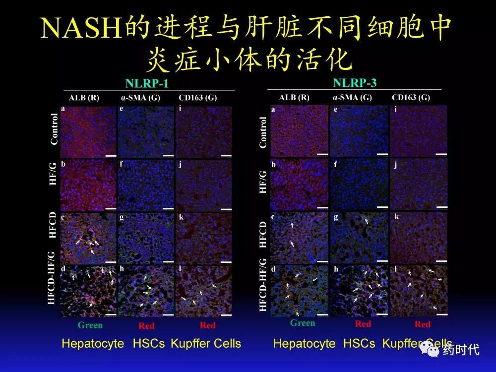 吴健教授 | NASH肝纤维的分子机制及干预靶点