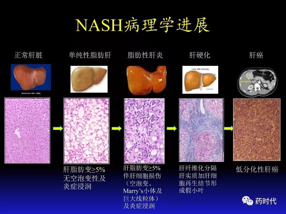 吴健教授 | NASH肝纤维的分子机制及干预靶点
