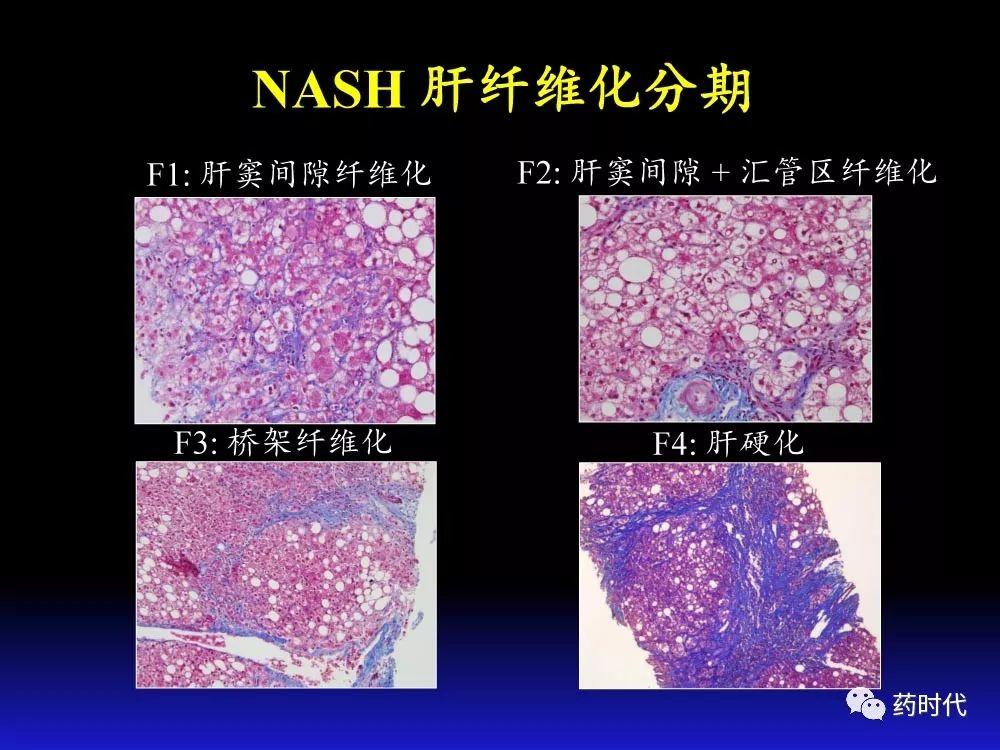 吴健教授 | NASH肝纤维的分子机制及干预靶点