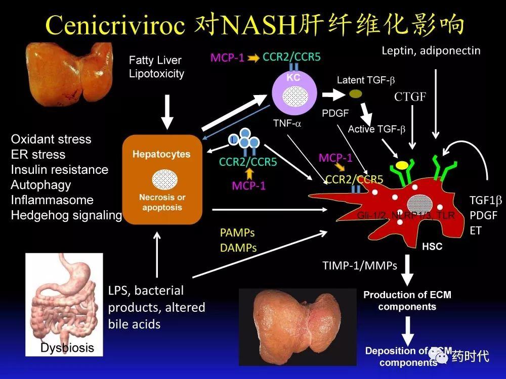 吴健教授 | NASH肝纤维的分子机制及干预靶点