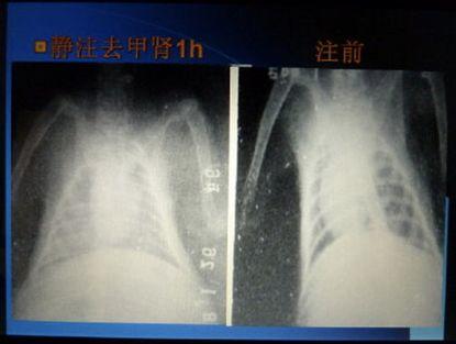 菠萝蛋白酶、酚妥拉明和山莨菪碱有望防治重症新型冠状病毒肺炎