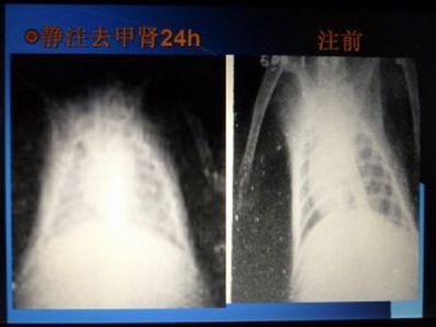 菠萝蛋白酶、酚妥拉明和山莨菪碱有望防治重症新型冠状病毒肺炎