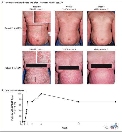 追药吧，IL-36单抗Spesolimab，免疫疗法中的后浪！