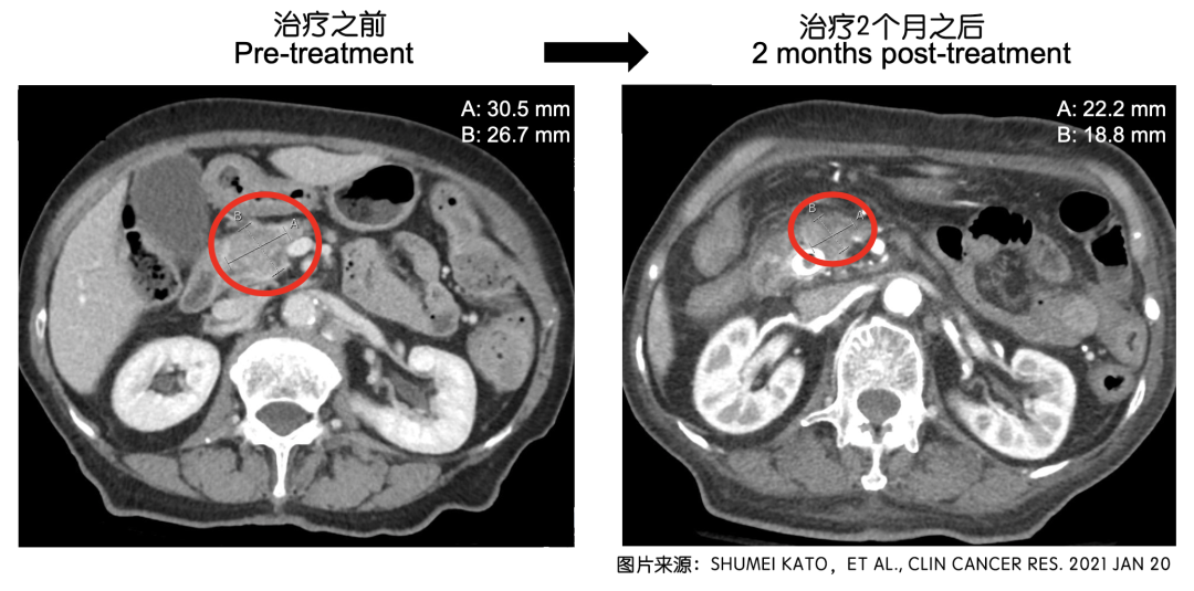 振奋丨众癌之王胰腺癌可通过曲美替尼联合帕博西尼治疗