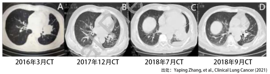 当EGFR、ALK和ROS1三个基因突变出现在一个病人身上