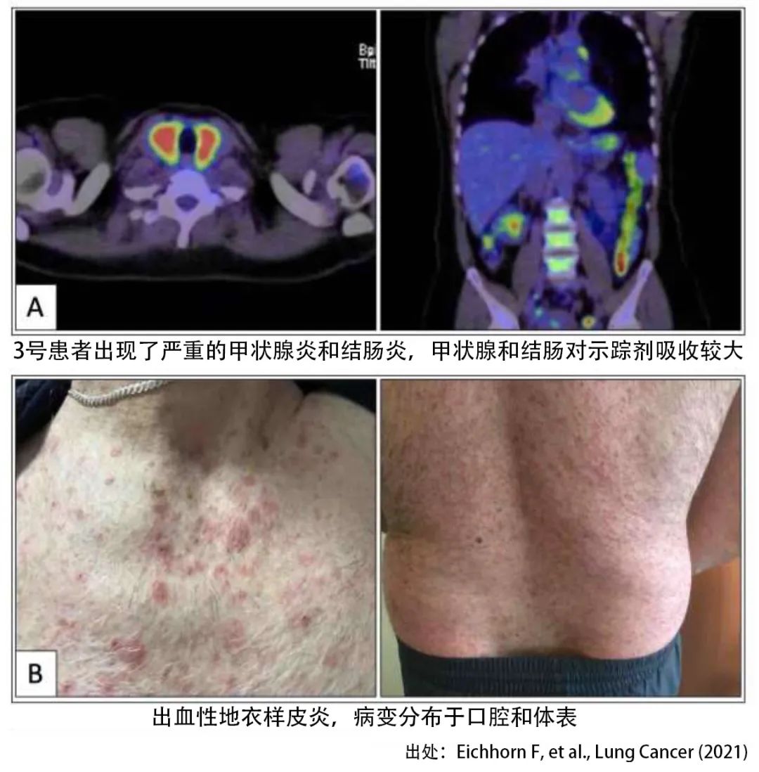 手术前用PD-1的效果与安全性如何？首个临床试验给出了答案