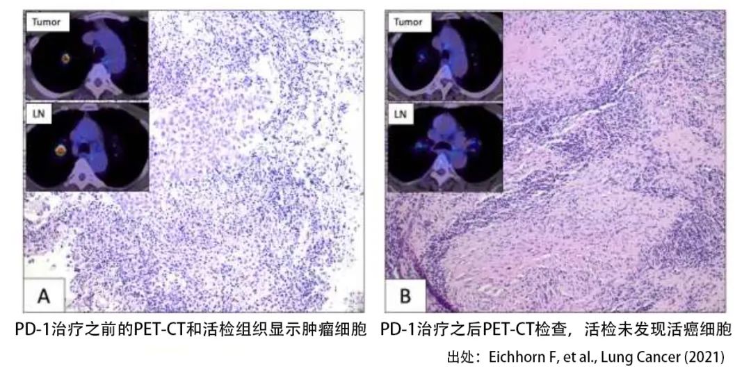 手术前用PD-1的效果与安全性如何？首个临床试验给出了答案