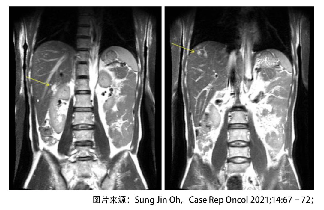 绝境逢生！晚期胃癌肝转移后怎样实现长期生存？