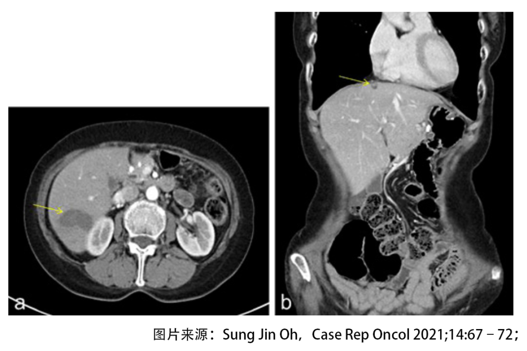 绝境逢生！晚期胃癌肝转移后怎样实现长期生存？