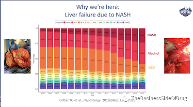 NASH专栏 | 万字闲谈NASH新药研发