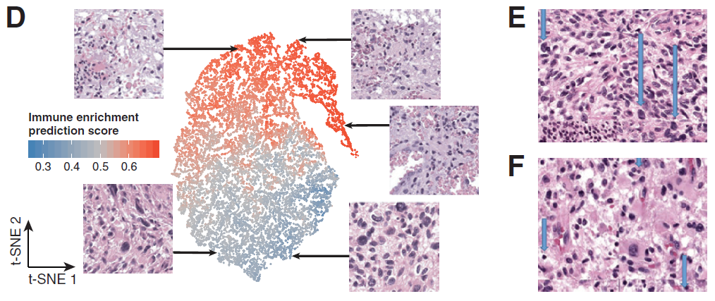 迄今最大胶质母细胞瘤“地图”，丁莉团队揭示致命脑瘤中起关键作用的生物图谱