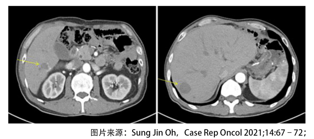 绝境逢生！晚期胃癌肝转移后怎样实现长期生存？