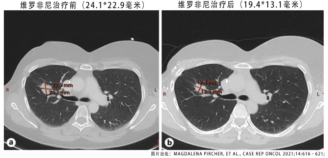 绝处逢生：晚期三阴乳腺癌发现驱动基因突变，靶向治疗病情缓解