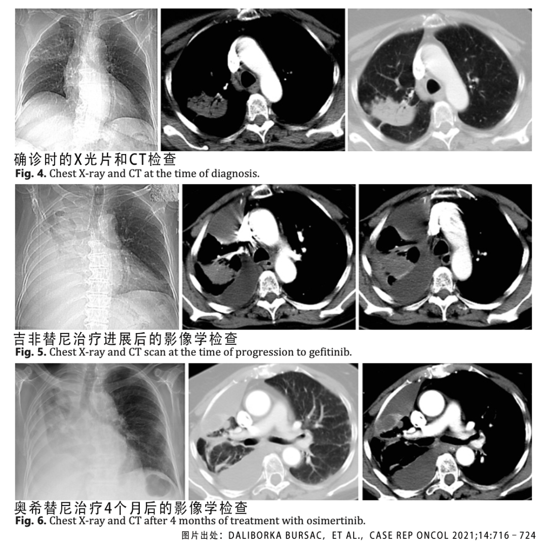 信否？肿瘤组织基因检测阴性，血液却检出可吃靶向药的基因