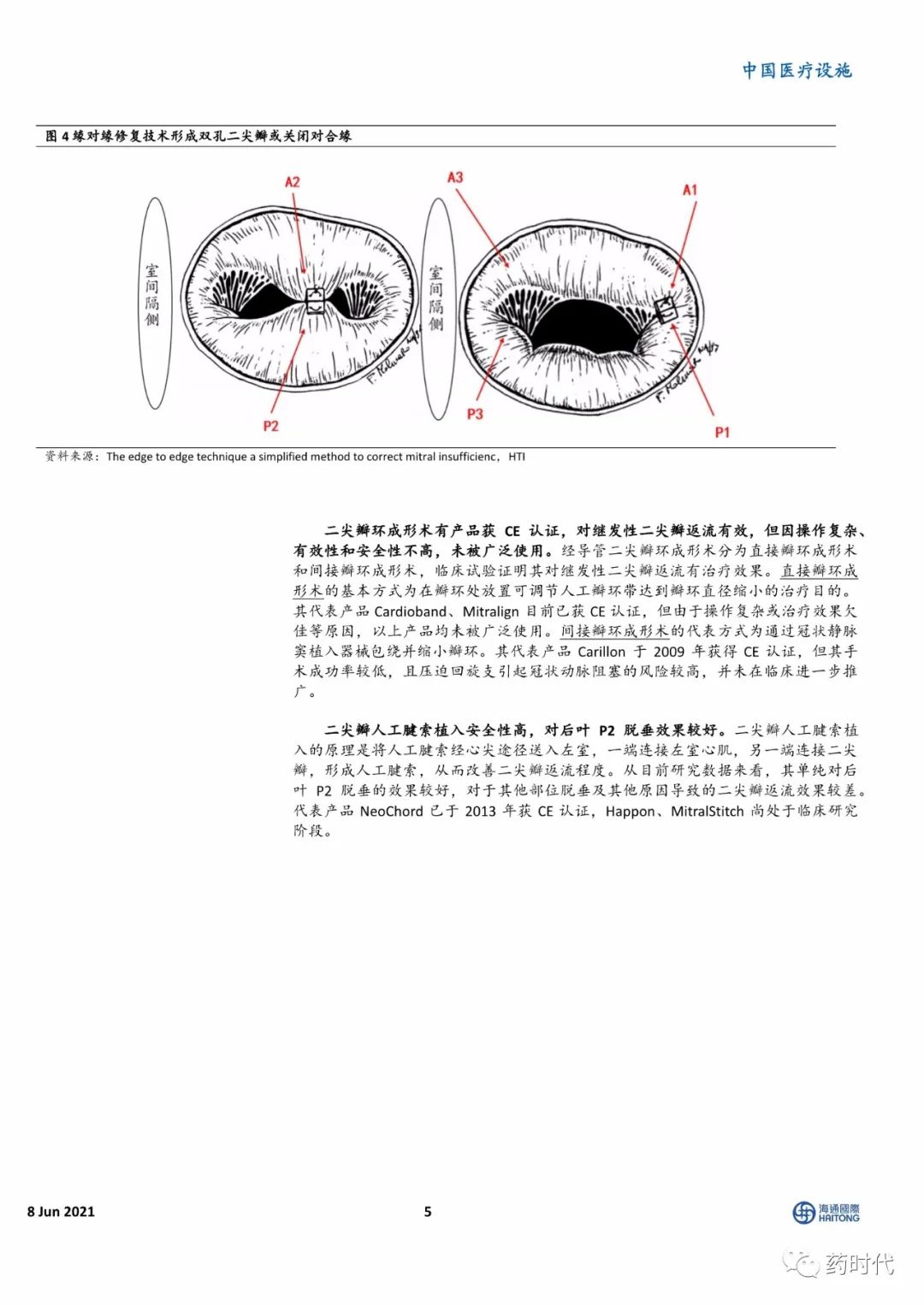 【海通医药】小瓣膜，大时代——二尖瓣、肺瓣行业研究