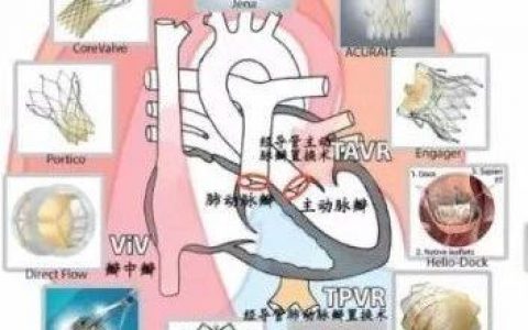 【海通医药】小瓣膜，大时代——二尖瓣、肺瓣行业研究