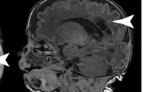 Cell子刊：肠道细菌影响大脑发育
