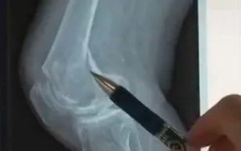 骨质疏松日趋严重，为何这种病东方女性比欧美女性更流行？