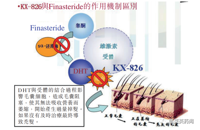 新药巡礼：超20余年无新药上市，福瑞他恩有望打破雄秃治疗困局