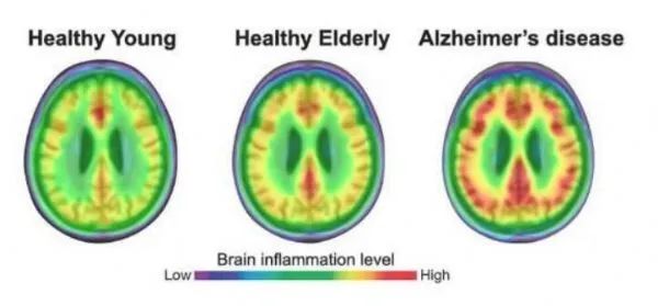 2021年终盘点 | 阿尔兹海默病研究领域重磅级成果！