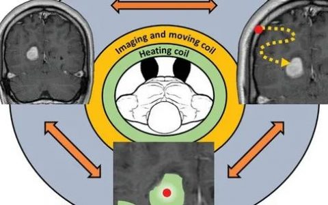 “烧死”肿瘤！科学家开发远程加热、磁性引导热种子的癌症新疗法