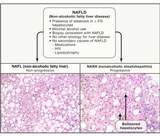 NASH“无药之局”谁来解？非酒精性脂肪肝药物研发概览