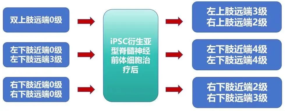 全球首例临床改善！中山三院联合士泽生物推进通用型iPSC再生神经细胞治疗脊髓损伤